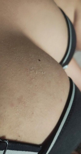 PEELING BREASTS