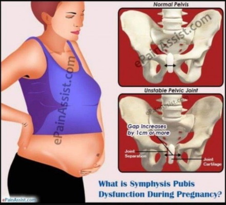 symphysis pubis dysfunction (SPD) 😢