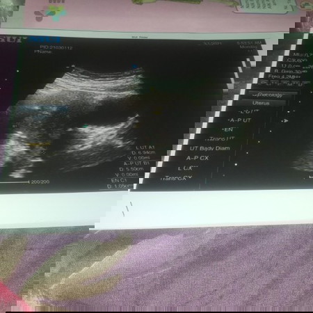 Kantung kehamilanku tidak terlihat atau belom berbentuk