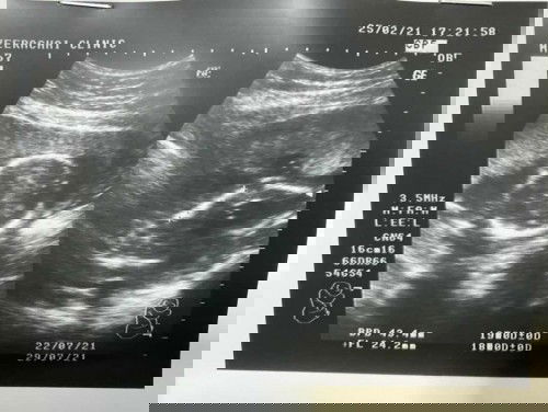 ท้องแรกของแม่วัย27