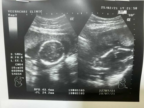 ท้องแรกของแม่วัย27