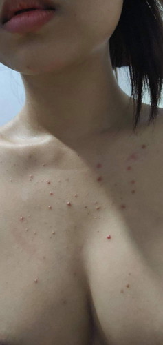 สอบถามอาการการเป็นสิวของคุณแม่แต่ละท่านค่ะว่าอาการเป็นยังไง สิวลดตอนไหน