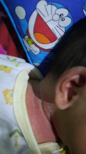 Lipatan di leher merah