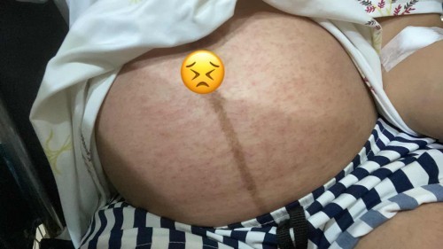 มีแม่บ้านไหนขึ้นผื่นแบบนี้บ้างค่ะ