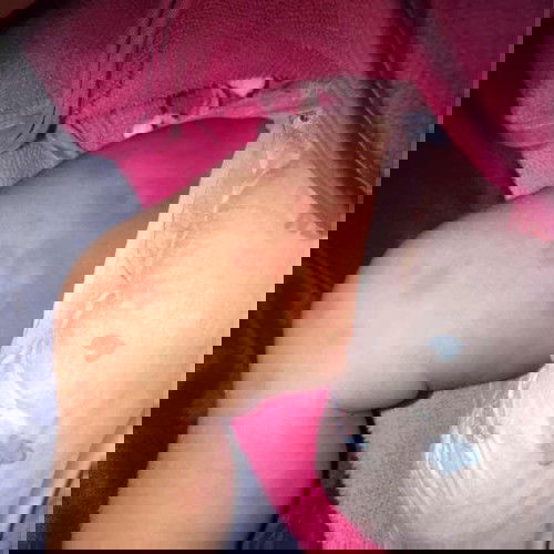 ผื่นอะไรคะ อันตรายมั้ย