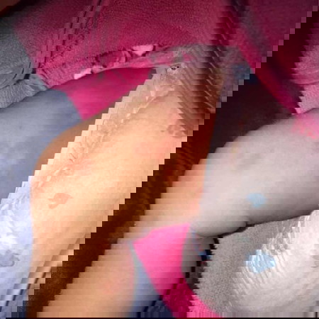 ผื่นอะไรคะ อันตรายมั้ย