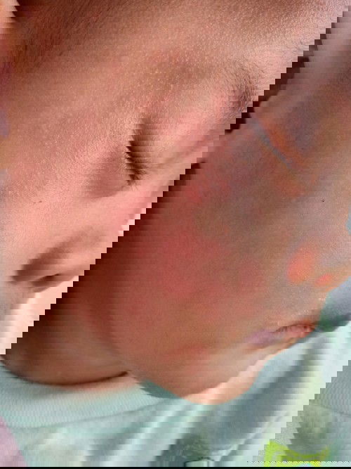 Merah2 setelah demam