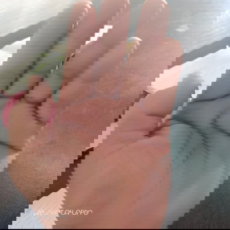 tnong momys kung normal lang bang parangvtinutusok ng karayum kamay ko tapos namamaga minsan diko ma