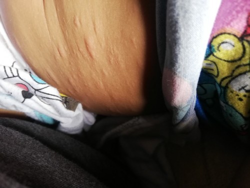 Rashes po si baby