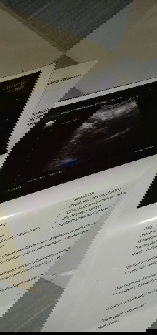 8 week belum terlihat janin