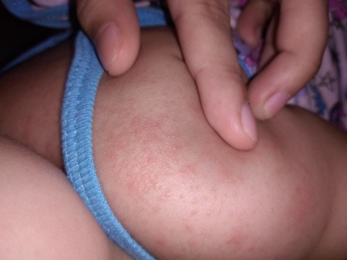 help po, rashes po ba to