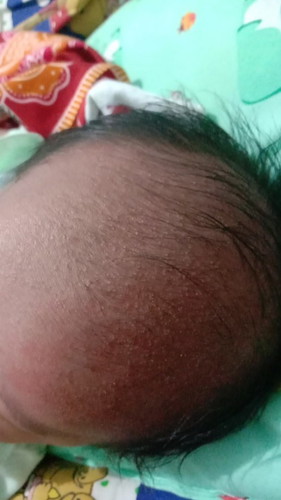 ruam di kepala bayi