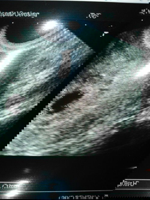 miscarriage due serious bleeding.