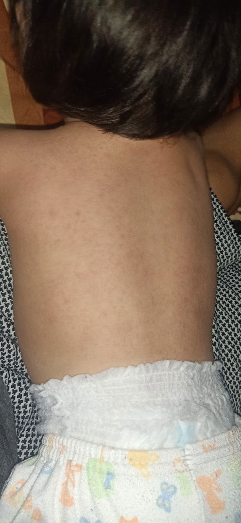 Campak di usia 13 bulan