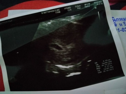 ตั้งครรภ์5+