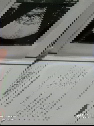 Sembelit trimester ke 2