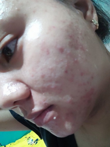 Dumadaming pimples