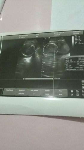 USG 30week๐ alhamdulillah normal dan sehat bund, semoga anak saya laki2๐ค