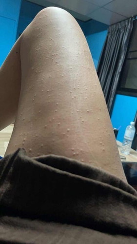 ผดคันทำยังไงถึงหาย