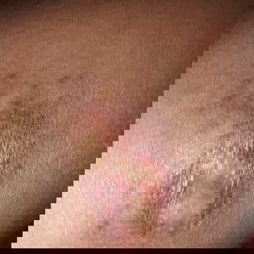 Adakah yg sama badannya pada biru" gini kaya aku ka??
Knpa ya hamil ak masuk 34week ka...