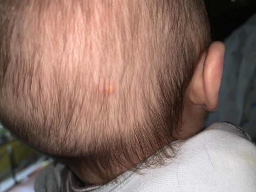 Is this an ingrown on my baby’s scalp?