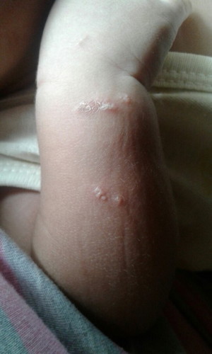Obat kulit