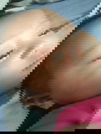Remedies for baby exzema