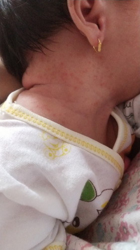 Bintik2 merah di leher bayi