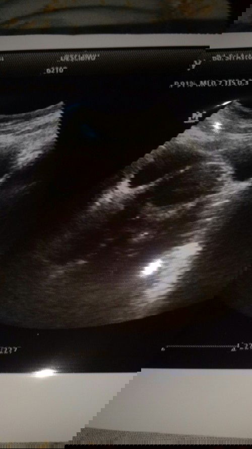Hamil 4w6d kantung belum terlihat jelas