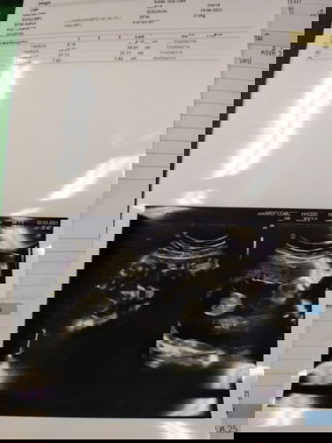 มีใครเคยฝากท้องตอน8เดือน บ้างคะ