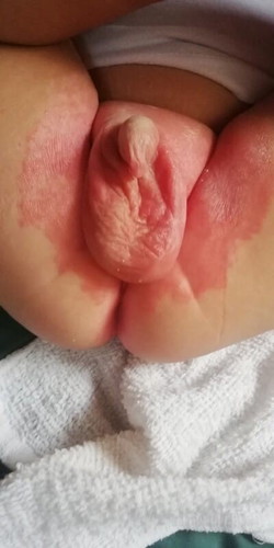 Rashes problem