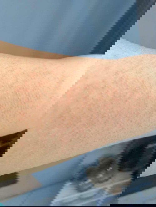 gatal dan muncul bintik merah