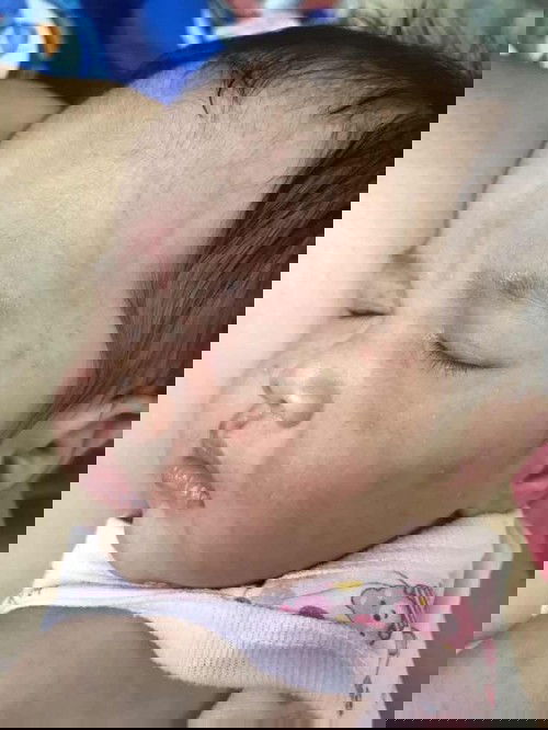 ผื่นแบบเดิมไม่หายสักที