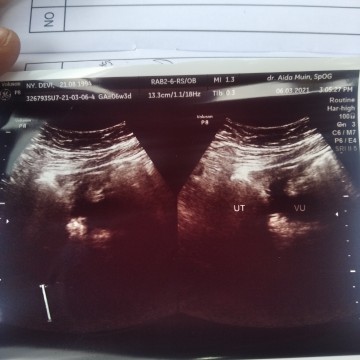 Di tespeck garis 2 tp samar2 USG nggak ada bhkn kantong nya pun blm ada ..