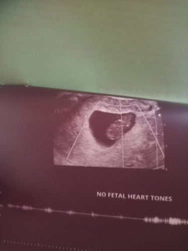 No heart fetal tone