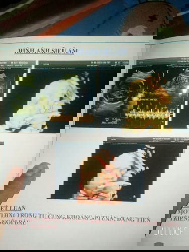 Con em 30 tuần được 1400g có nhỏ không các mẹ.