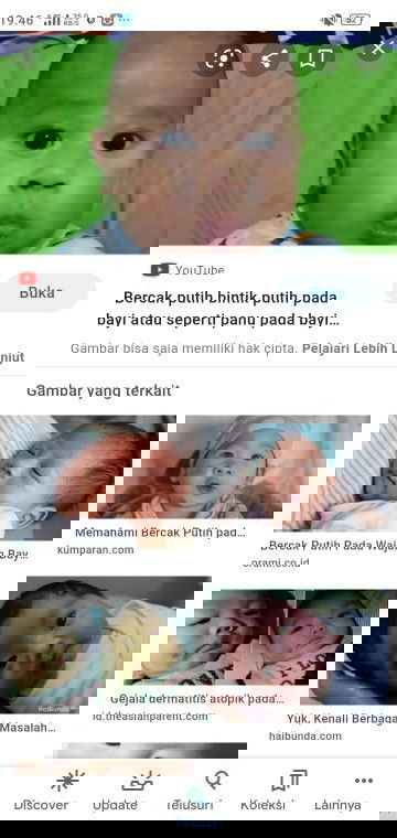 Bercak putih pada wajah bayi