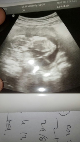 Pada pemeriksaan minggu ke 13 dokter bilang air ketuban saya kurang sehingga posisi bayi saya masih