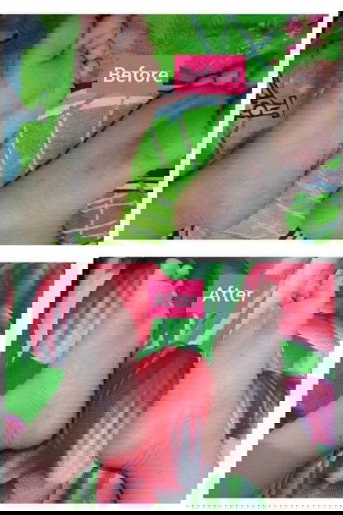 Ketika anak pertana kena HFMD /flu singapore