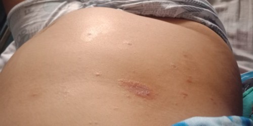 Sobrang kati po nya last month maliit lang po ito ngayon parang dumadamit na ano kaya pwde igamot?