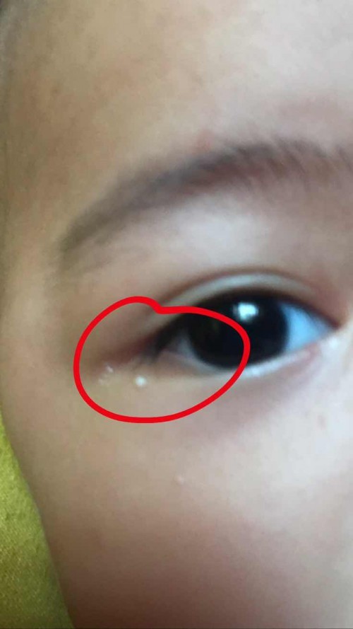 Bintik putih dibawah mata