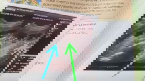 Hasil Usg 2 Kantong Janin Apakah Kembar identik atau non identik ya?