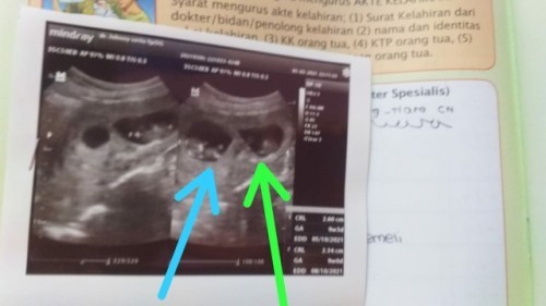 Hasil Usg 2 Kantong Janin Apakah Kembar identik atau non identik ya?