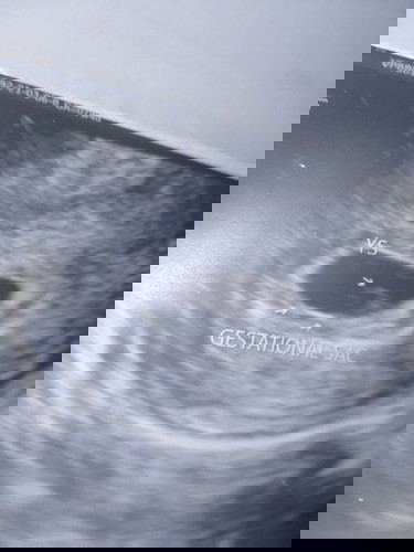 6weeks and 2 days ultrasound!