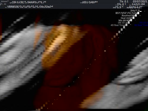 Baby 3D Ultrasound