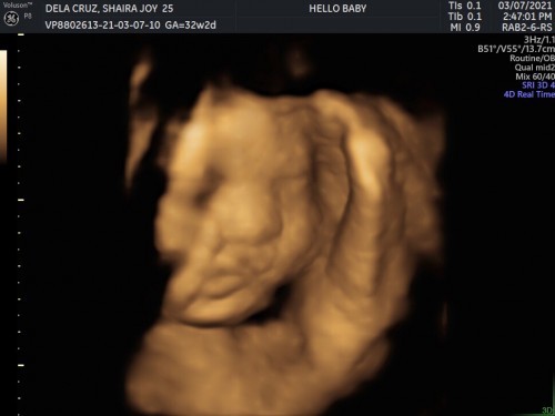 Baby 3D Ultrasound