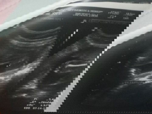 ULTRASOUND RESULT