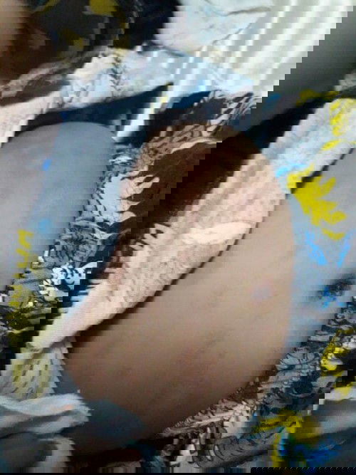 ลูกน้อยใครเคยเป็นแบบนี้บ้างคะ