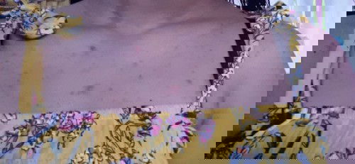 Any tips po o sa mga nakakaalam natural lang po ba to? Pinalibutan na po ng tigyawat dibdib at likod