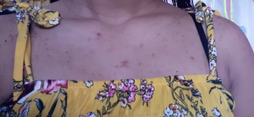 Any tips po o sa mga nakakaalam natural lang po ba to? Pinalibutan na po ng tigyawat dibdib at likod